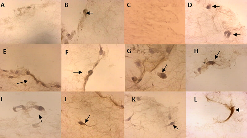 FIGURA 5. Células mesenquimales de la pulpa dentaria humana sobre la matriz de colágeno tipo I, catorce y veintiún días de inducción odontogénica-osteogénica.