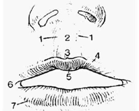 Fig 1. Anatomía topográfica de los labios 1. Columna de los filtros. 2. Surco o fosita del filtro. 3. Arco de Cupido. 4. Línea blanca del labio superior. 5. Tubérculo. 6. Comisura. 7. Bermellón.