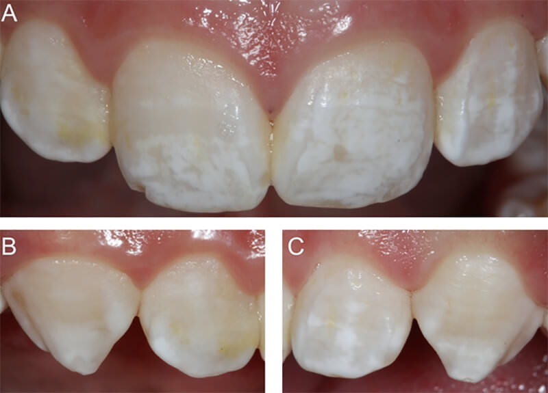 Figura 1. Vista inicial antes del tratamiento. Observe las manchas blancas generalizadas y levemente amarillas en el incisivo lateral derecho (diente 12).