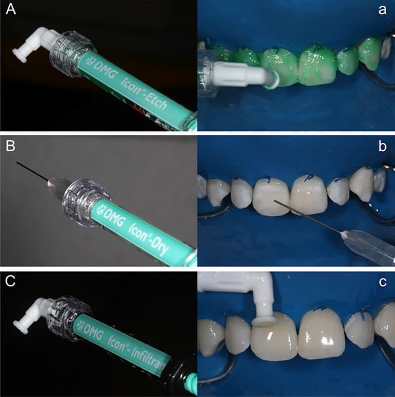 Figura 2. Imagen del Sistema ICON y su aplicación. Aislamiento con dique de goma natural. A/a. La jeringa con gel acido permite ensamblar una punta aplicadora del sistema que permite una cómoda aplicación del gel sobre las superficies dentales, luego de 120 s de acondicionamiento, el gel debe ser profusamente lavado por 30 s; B/b. La jeringa de etanol posee una aguja de aplicación. Sobre las superficies deshidratadas es aplicado el etanol por 30 s y secado con aire; C/c. La resina infiltrante es aplicada dejándola actuar por 3 min, los excesos deben ser removidos antes de la fotoactivación por 40 s y luego se realizar un replicación por 1 min.