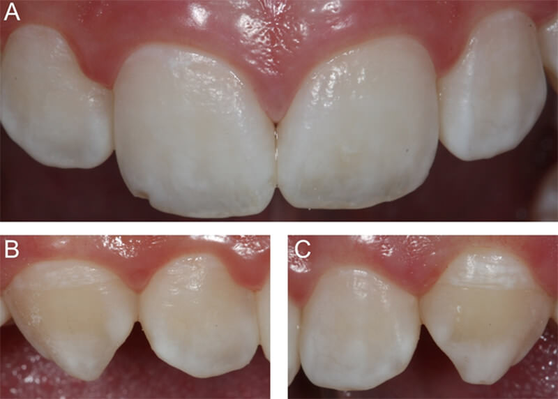 Figura 4. Vista final luego de 1 semana. A - C. Observe el enmascaramiento del las machas de fluorosis y homogenización del aspecto general.