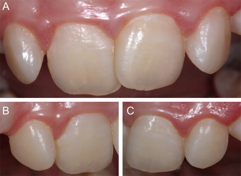 Figura 6. Vista final luego de 1 semana. A - C. Observe el enmascaramiento del las machas de fluorosis y homogenización del aspecto general.