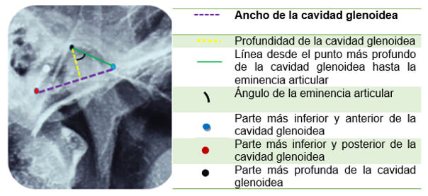 Imagen 1. identificación de los puntos y lineas de referencia para el análisis de la cavidad glenoidea.