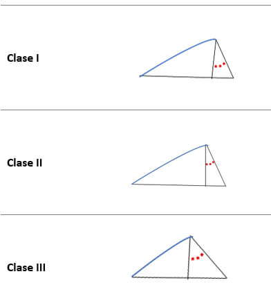 Imagen 2. Diagrama del promedio de las medidas de ancho, profundo y angulación de la cavidad glenoidea respecto a la clase esquelética.