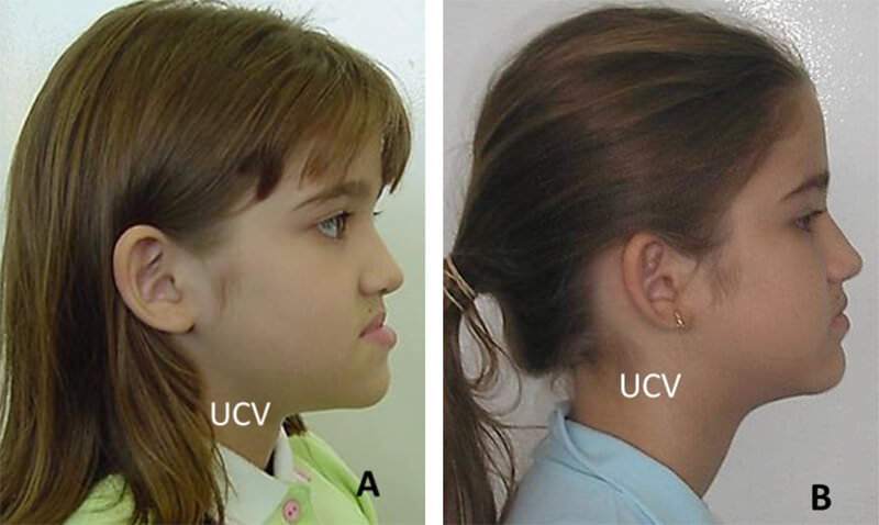Fig. 1. Fotografía clínica de perfil de paciente con maloclusión Clase III, tratada con expansión y protracción maxilar. A, pre-tratamiento; B, post-tratamiento. Se puede evidenciar los cambios en el perfil al finalizar el tratamiento.