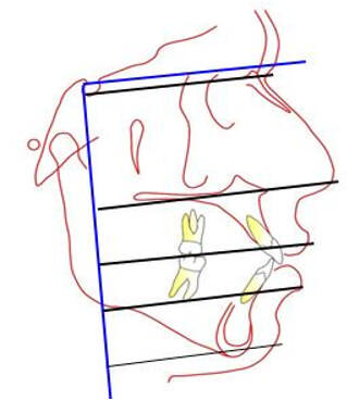 Fig. 3. Vertical de Silla a los puntos N´,Pn, Ls,Li,Pg´y Angulo Nasolabial