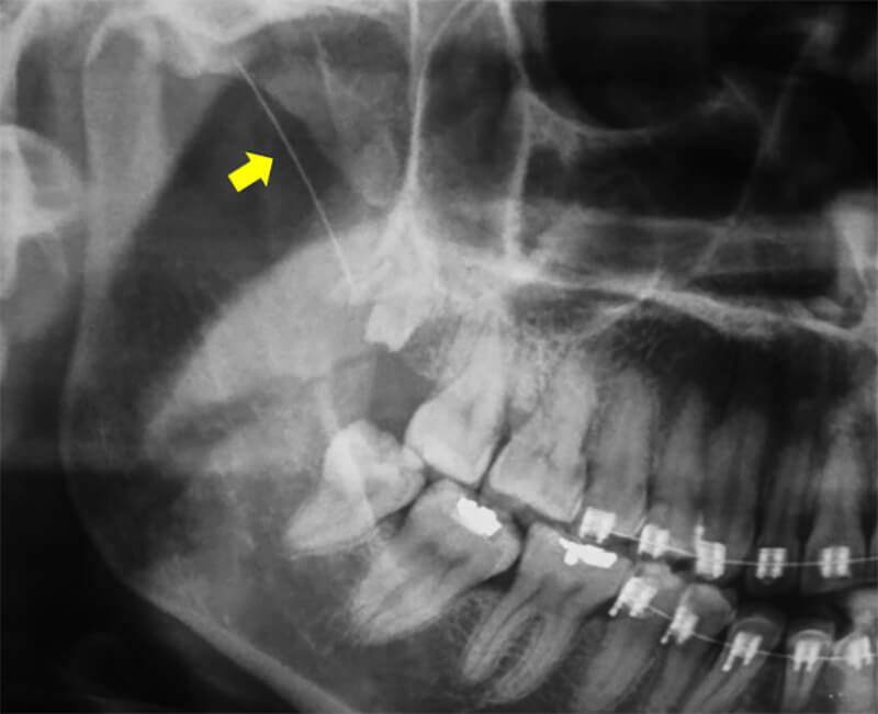 Fig 1. Radiografías panorámica inicial: mustra línea radiopaca compatible con cuerpo extraño en zona pterigomaxial (flecha)