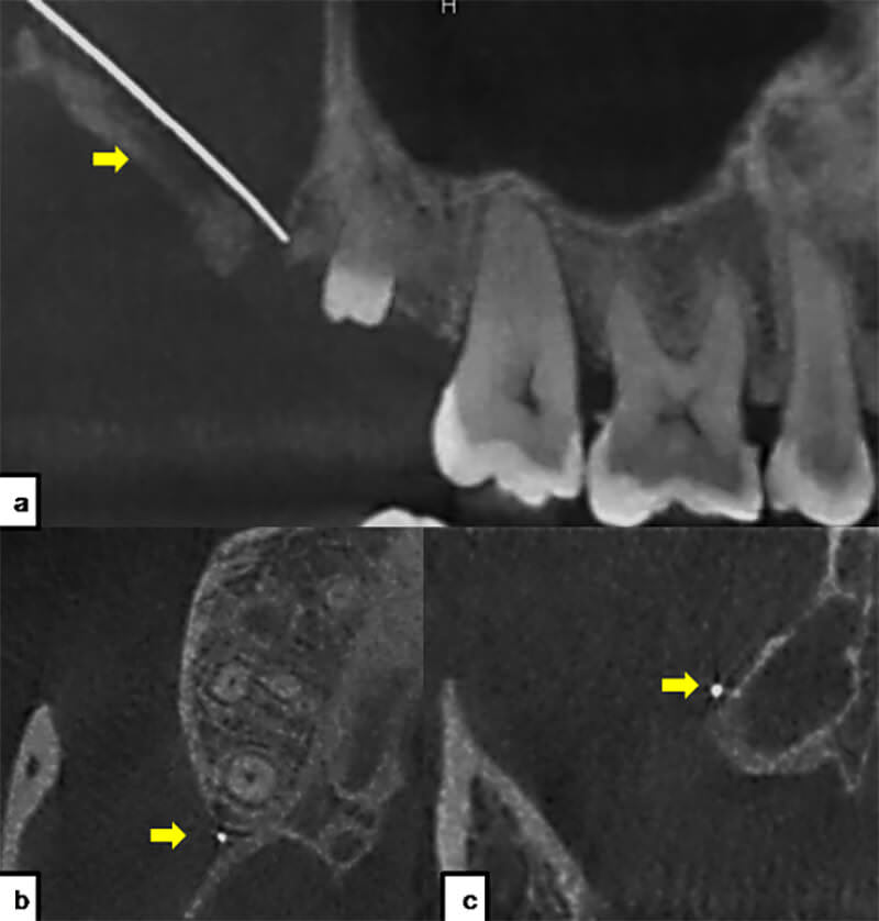 Fig 2. Tomografía computarizada.<br>a: corte sagital; b: corte axial; c: corte coronal