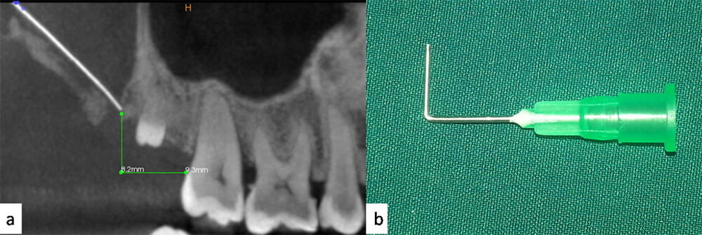 Fig 3. Guía quirúrgica: a: medidas de referencia obtenidas de la tomografía computarizada (9.3mm. en sentido posterioranterior y de 8.2mm. en sentido craneocaudal). b: aguja 21 G de 1 ½ moldeada