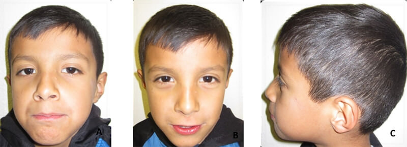  Figura 1 Fotografías Extraorales del paciente (A) Frente, (B) Sonrisa (C) Perfil