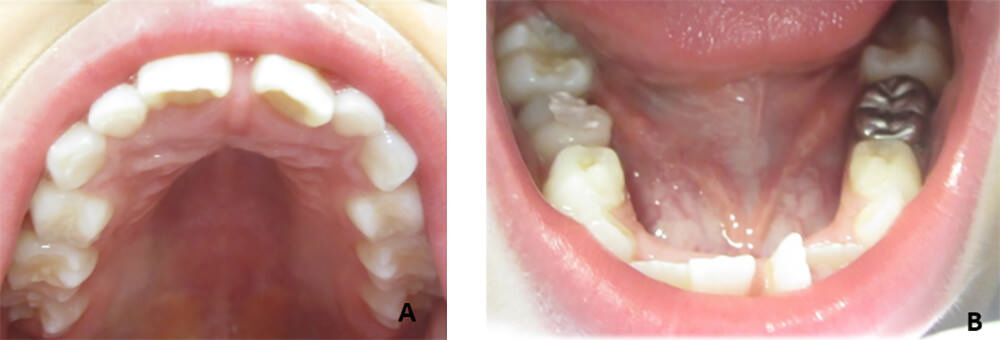 Figura 2 Fotografías Intraorales del paciente (A) Superior, (B) Inferior