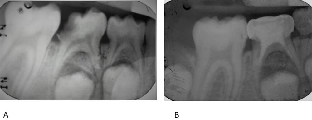 Figura 3   Radiografía periapical inferior derecha (A)  inicio, (B) Final