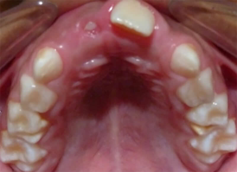 Imagen 10: Fotografía radiografía intraoral oclusal superior, a los tres meses