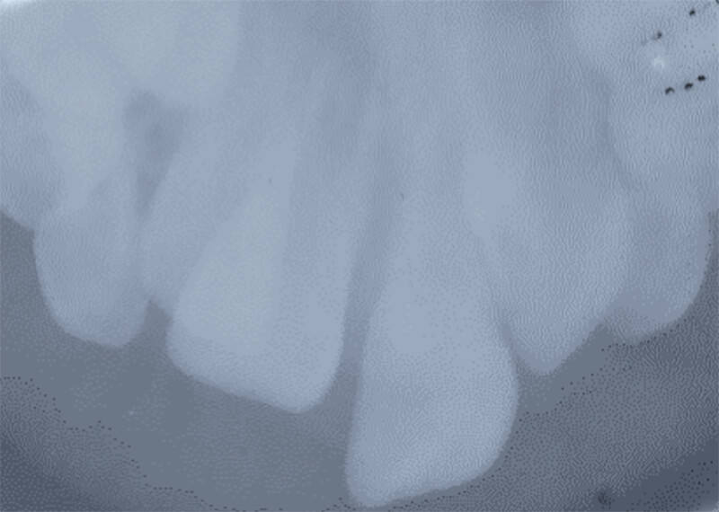 Imagen 11: Radiografía intraoral oclusal total superior, a los tres meses