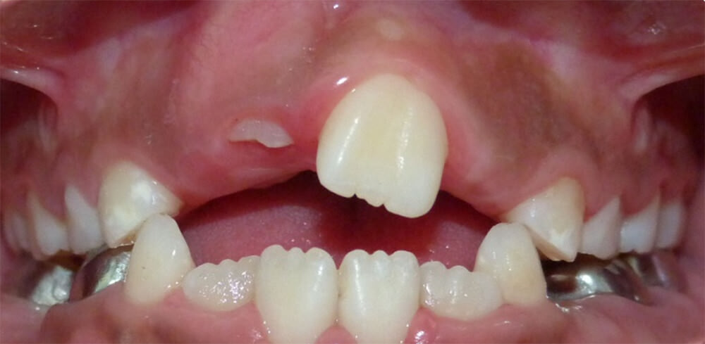 Imagen 12: Fotografía intraoral frontal, a los seis meses