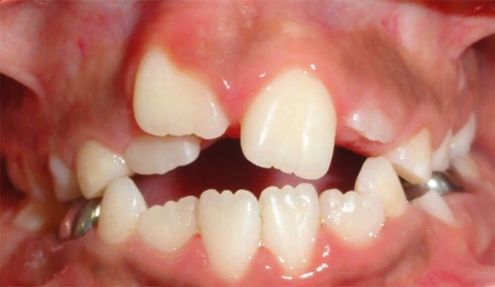 Imagen 15: Fotografía intraoral frontal luego de 9 meses