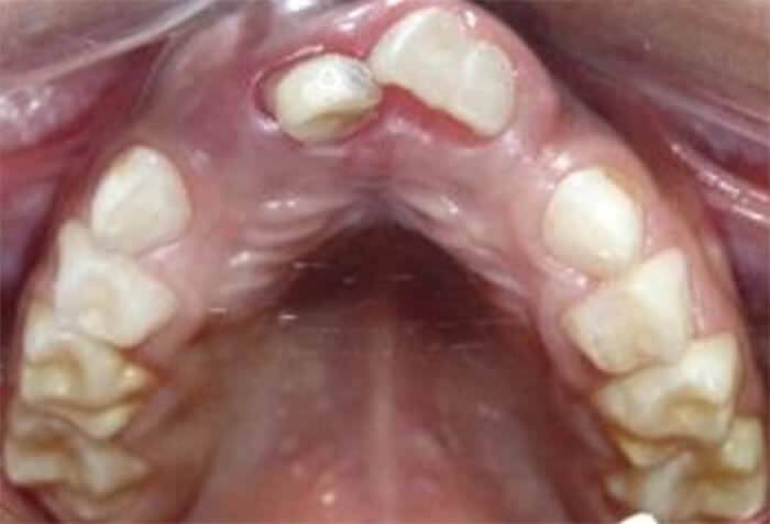 Imagen 2: Fotografía intraoral oclusal superior