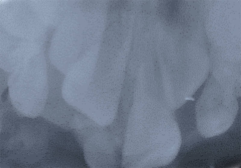 Imagen 5: Radiografía intraoral oclusal 