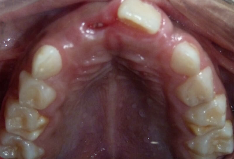 Imagen 7: Fotografía intraoral oclusal superior postoperatoria