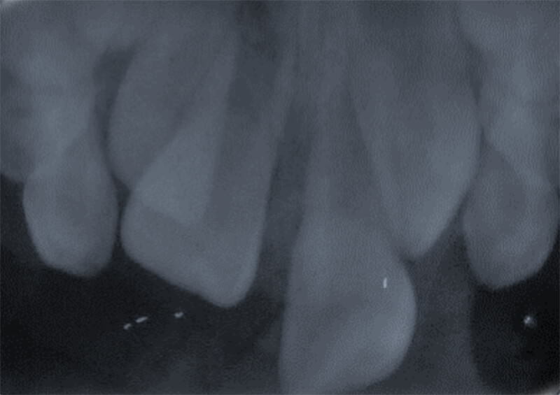 Imagen 8: Radiografía intraoral oclusal total superior postoperatoria