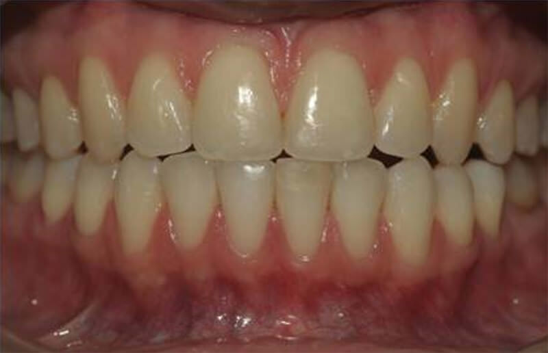 Figura 1 Aspecto dental inicial (coloración amarillenta en cervical de todos los dientes).