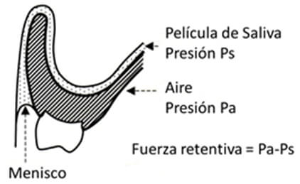 Figura 2 Retención debida al diferencial de presión entre la película de saliva y el aire
Tomado de Basker RM, Davenport JC 2