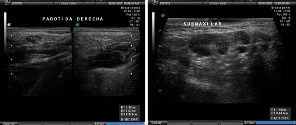 Fig. 1 Ultrasonido de alta resolución de glándula Parótida y Submandibular