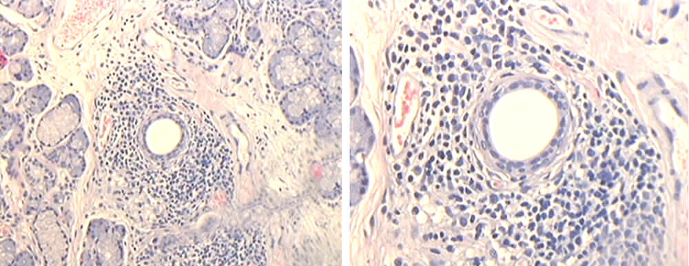 Fig. 2 Biopsia de glándulas salivales accesorias de labio inferior Grado II en pacientes con Síndrome de Sjögren