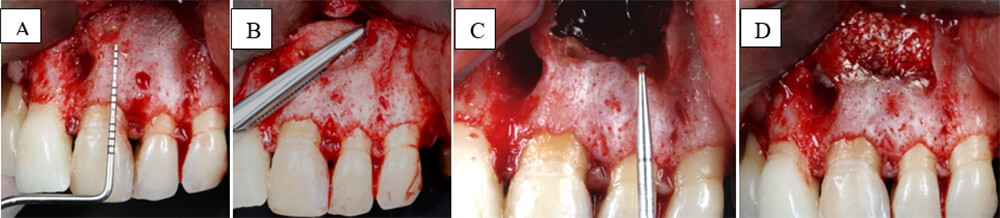 Figura 2 (A) Erosión de la cortical vestibular; (B) legrado y la eliminación de la lesión; (C) Apicectomía dientes 21 y 22 asociados y sellado apical con MTA; (D) Colocación del injerto óseo en el defecto dado por la lesión.