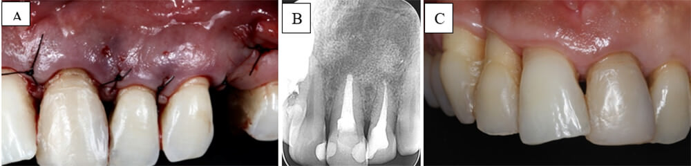 Figura 3 (A)	Sutura con nylon 5.0; (B) Control radiográfico después de 7 meses; (C) Foto clínica 7 meses después.