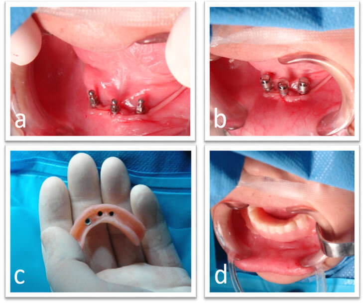 Fig 2. Fotografías Introperatoria: a. Tres implantes MDI colocados (10mm, 1.8 Ø) b. Implantes MDI colocados con house coping. c. Prótesis inferior con los house coping. d. Colocación de prótesis en boca.