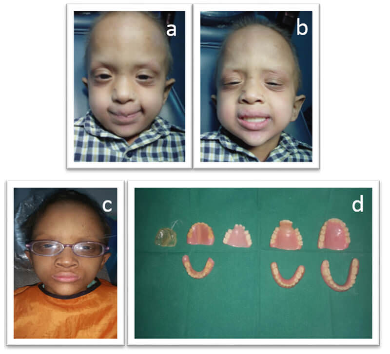 Fig. 4.a-b. Fotografía extraorales postoperatorio a los 6 meses. c. Fotografía extraorales del seguimiento a los 10 años d. Fotografía de las diferentes etapas de la rehabilitación protésica del paciente.