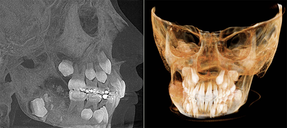Figura 2: Estudio tomográfico donde se observa la lesión de FOA a nivel del gonion del lado derecho del maxilar inferior