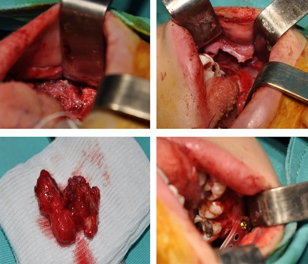 Figura 3: fotos de secuencia técnica quirúrgica en la exéresis del FOA