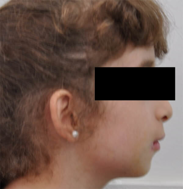 Figura 4: Vista de perfil donde se observa relación simétrica de ambos maxilares