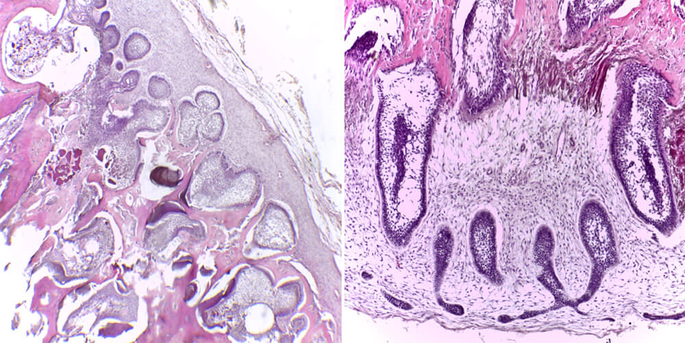 Fig. 7: H/E 40X Tumor bien delimitado de tejido conectivo con cordones y nidos de epitelio  odontogénico dispuestos en cordones y  folículos con variable formación de tejidos mineralizados como matriz de esmalte y dentina.