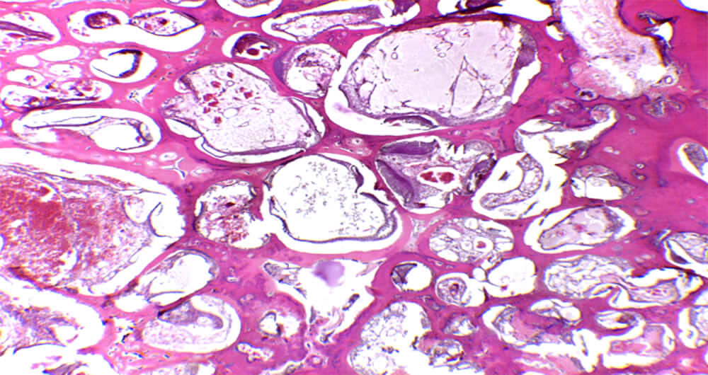 Fig. 8: H/E 40X Cordones y nidos de epitelio odontogénico desorganizado formando folículos y  variable cantidad de tejidos mineralizados como matriz de esmalte, dentina y cemento.