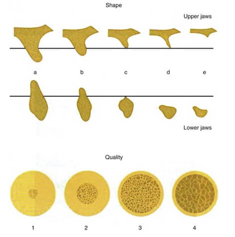 FIGURA 1 Clasificación de la forma residual de los maxilares y la calidad del hueso de los maxilares, según Lekholm y Zarb-1985-. (De  Lindhe, K. Karring,T. ‎ Lang, L.  Periodontología clínica e implantología odontológica. 5ta ed. Madrid: Ed Medica Panamericana; 2009.p. 53