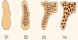 FIGURA 2. Las cuatro densidades óseas encontradas en las regiones edéntulas del maxilar y de la mandíbula (De Misch, C. Implantología Contemporánea. 3ra ed. España: Elsevier Mosby; 2009.p 135.
