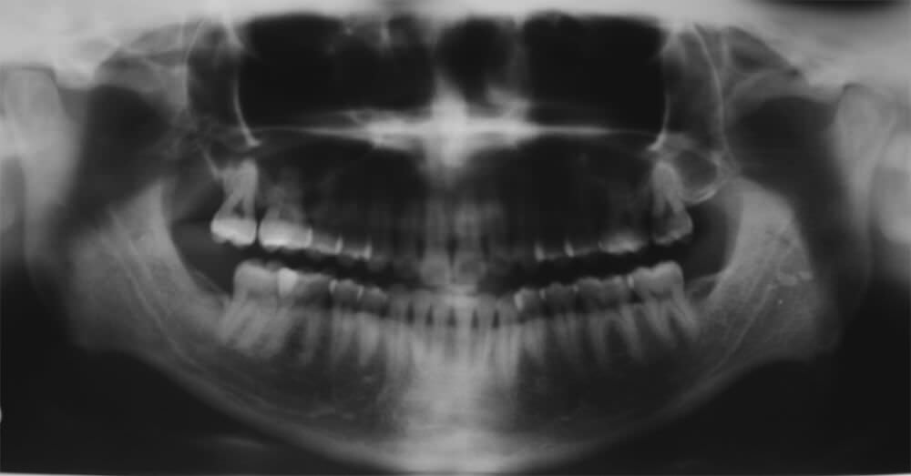 Figura Nº9. Control post-operatoria 6 meses. Vista oclusal