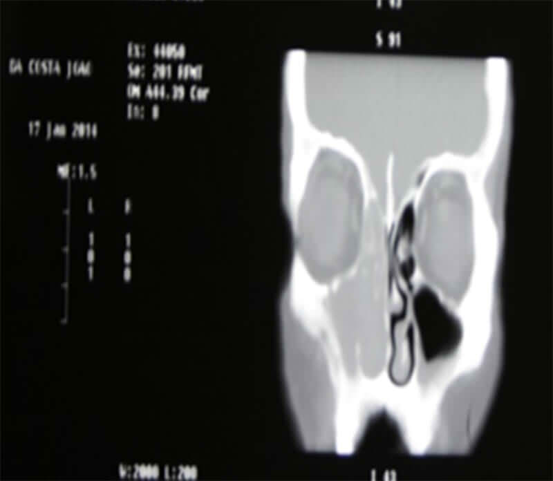 Fig. 3: TAC con contraste de senos paranasales en corte coronal