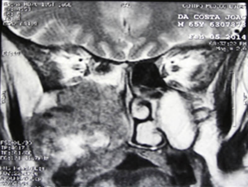 Fig. 4: RM en corte coronal