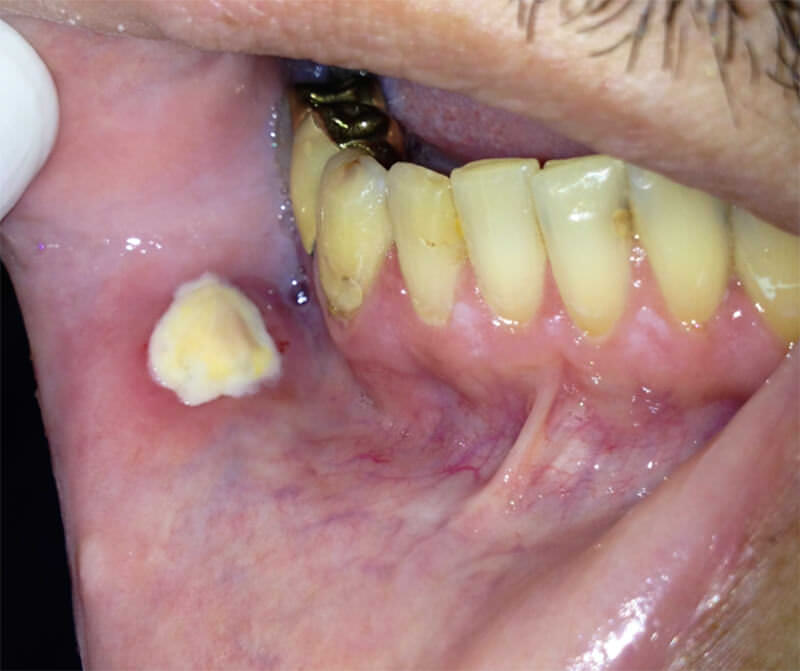 Figura 1 Infiltración leucémica en el lado interior del labio inferior. Fuente propia