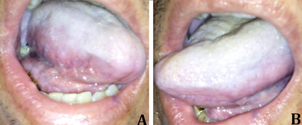 Figura 3A e 3B Condición bucal pos-quimioterapia. La Mucositis grado 1 causando moderado desconfort al paciente. Fuente propia