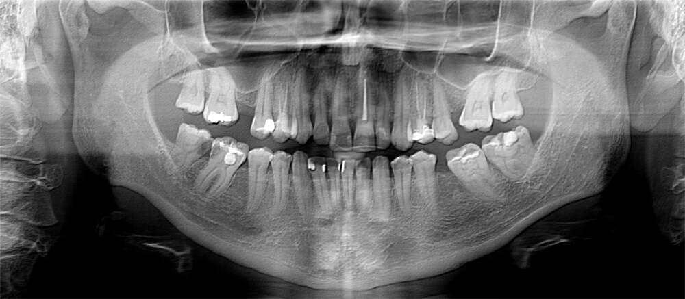 Figura 2. Ortopantomografía. Figura 2. Orthopantomography.