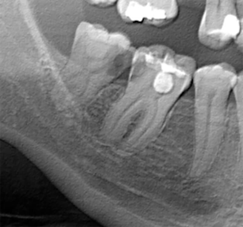 Figura 3. Detalle de Ortopantomografía. Figura 3. Orthopantomography detail.