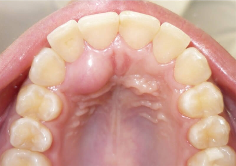 Figura 1. Apariencia clínica de la lesión se extiende desde el diente 11 hasta el 13