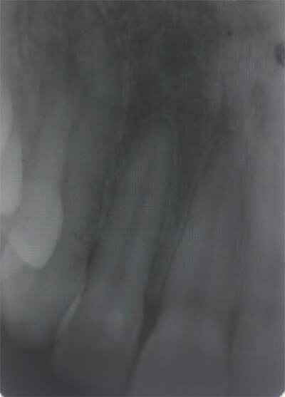 Figura 2. Radiografía periapical zona 21l Imagen ligeramente radiolúcida a nivel apical 