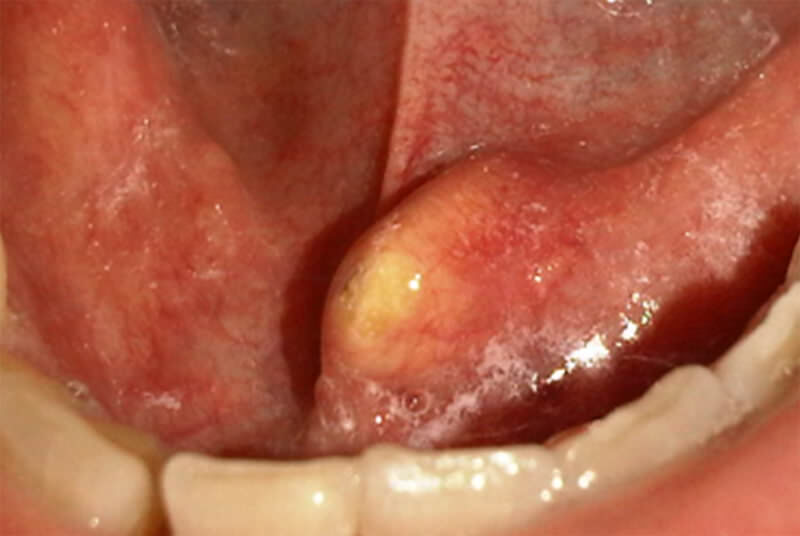 Figura 1: Imagen clínica de lesión en piso de boca