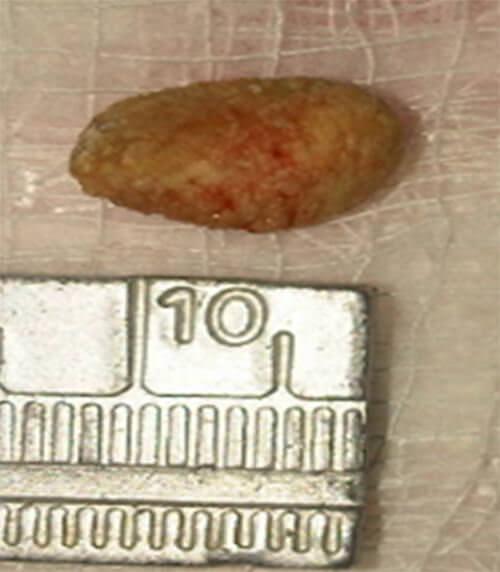 Figura 3: Imagen macroscópica de sialolito posterior a su remoción quirúrgica